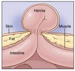 hernia curable by ayurvedic medicine