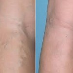 HOME REMEDIES TO PREVENT VARICOSE VEINS FROM OCCURING