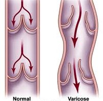 why does varicose vein occur in women and aged