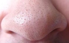 how to get rid of blackheads and white heads on skin