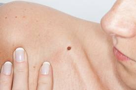 Are the tiny red moles on your skin cancerous?