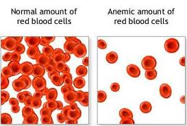 HOW TO TREAT ANAEMIC CONDITION