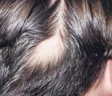 Alopecia Areata