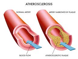 Natural foods that lowers cholesterol