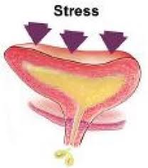 Urinary stress incontinence