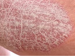 Natural-Remedies-for-Psoriasis