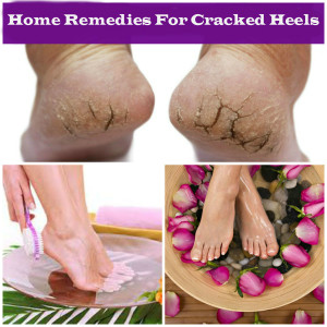 Home-Remedies-For-Cracked-Heels (2)