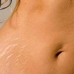 natural ways to remove stretch marks